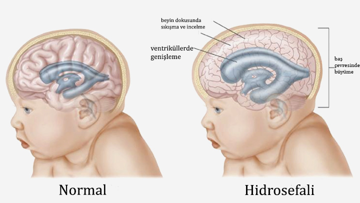 hidrosefali-nedir