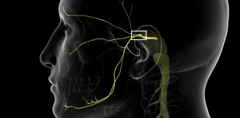trigeminal-nevralji