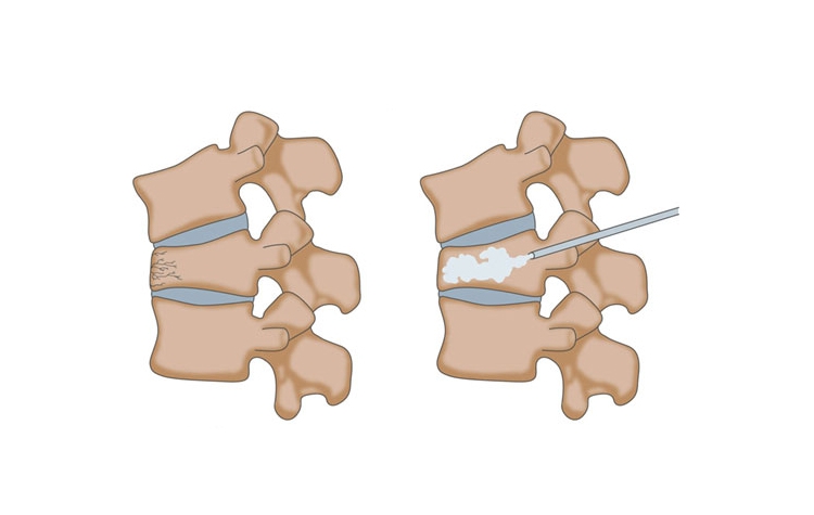 vertebroplasti-nedir